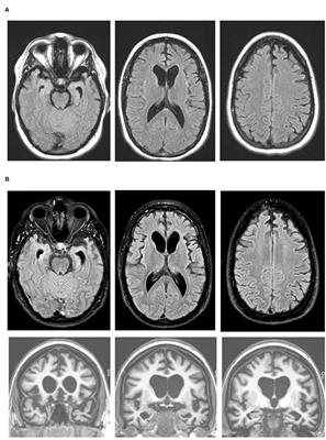 Frontiers | Case Report: Early-Onset Behavioral Variant Frontotemporal